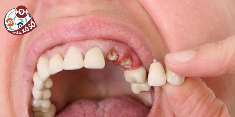 Hiểu rõ ý nghĩa về nằm mơ thấy rụng răng là gì